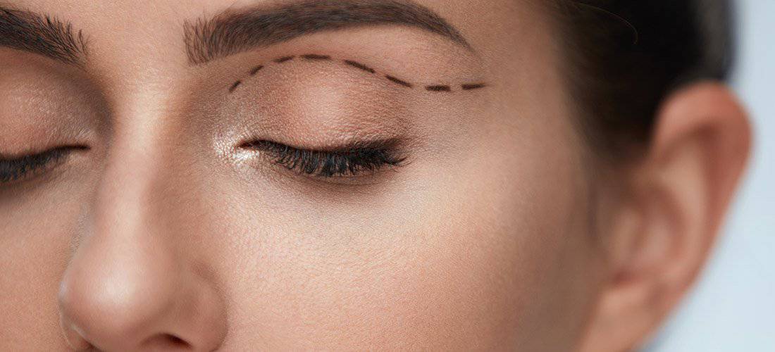 Botox or Eyelid Surgery