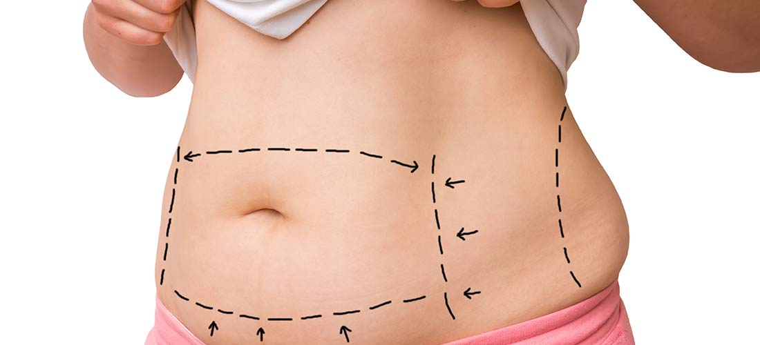 How Much Time Off After A Tummy Tuck