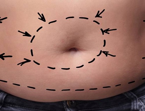 Liposuction Basics