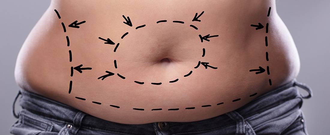 Liposuction Basics