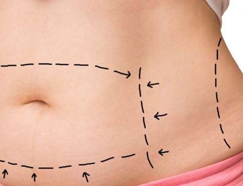 Maintaining the Results of Your Tummy Tuck