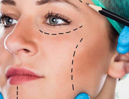 Misconceptions About Facelift