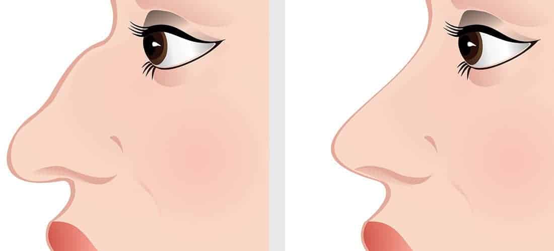 Nose Job Recovery Tips