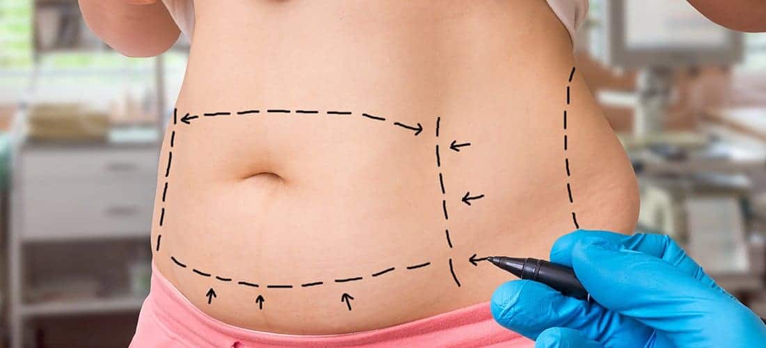 Tummy Tuck Women's Institute of Cosmetic & Laser Surgery