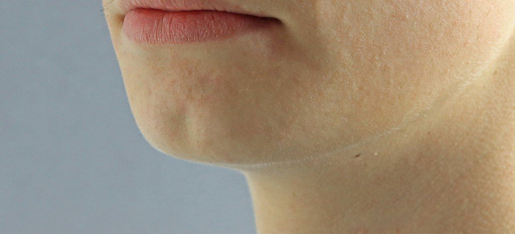 Cleft Chin Correction | Women's Institute Cosmetic Surgery